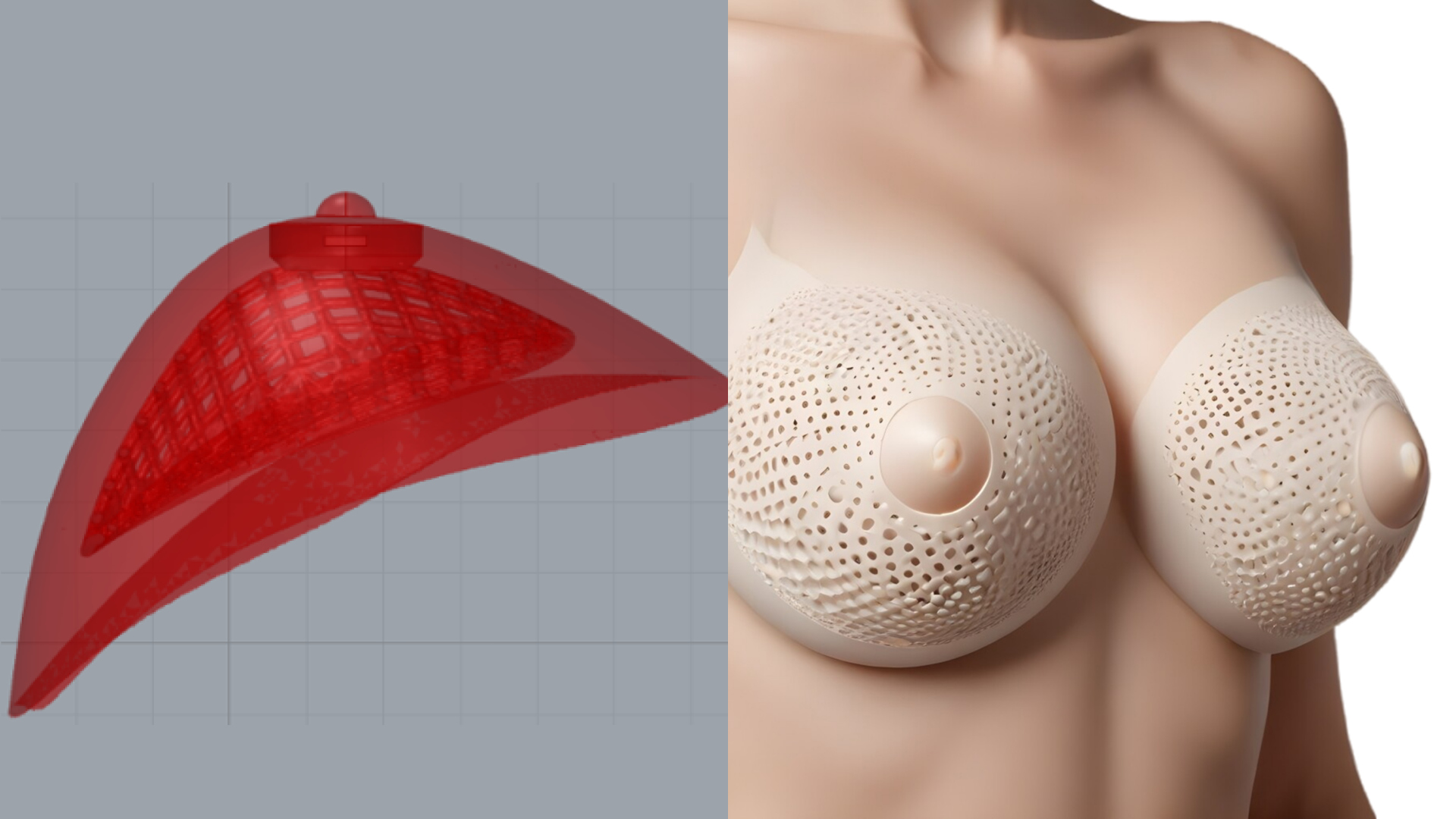 Silicone 3d printing personalized breast prostheses 
