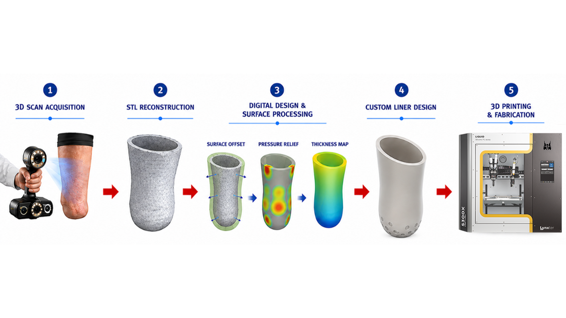 Figure 1 Workflow for Patient Specific Liner Fabrication
