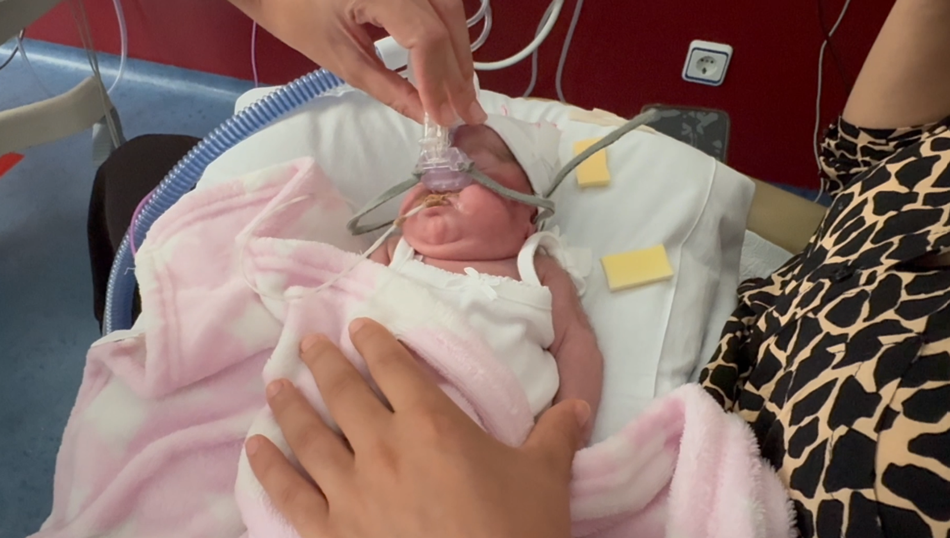 Infant suffering from a malformation